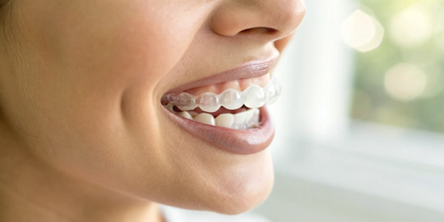 How Do Clear Aligners Work? An Expert Guide — Bellaire Modern Dental ...